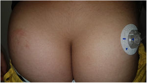 Subacute eczematous eruption on the left buttock of a patient using the Omnipod insulin pump.