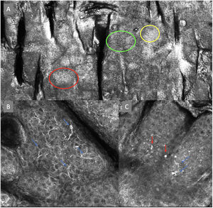 Confocal microscopy images in high epidermal layers. Top (A). Presence of honeycomb pattern (red circle), cobblestone pattern (yellow circle), and disorganized epidermis with dendritic cells (green circle). Bottom. Detail of pagetoid growth cells. Left (B). Dendritic cells (blue arrow). Right (C). Pleomorphic, round (red arrow), and dendritic cells (blue arrow).
