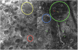 The image to the left (A) illustrates an epidermal architectural disorder with presence of button-like blood vessels, one of them indicated by a red circle, and an atypical honeycomb pattern (yellow circle), which is a typical image of Bowen