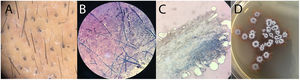A) Trichoscopic image of corkscrew hairs typical of black dot ringworm. B) Septate hyphae on KOH examination. C) Endothrix parasitization of the hair shaft by the fungus. D) Isolation of T. tonsurans on Sabouraud glucose agar with chloramphenicol.