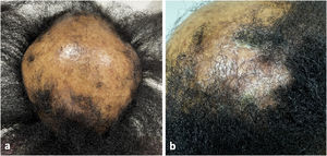 (a) Frontoparietal cicatricial alopecia interspersed with erythematous scaly papules and plaques, surrounded by rough and dry hair shafts of lupus hair. (b) Scaly erythematous alopecic plaque on the right parietal region of the scalp.