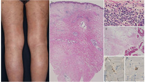 (a) Wood-like hardening of the bilateral lower extremities. (b) Histological features showing diffuse dermal sclerosis, thickened fibrous septal connective tissues with mononuclear cells infiltration in the subcutaneous tissues. (c) Higher magnification showed perivascular infiltration containing a number of eosinophils in the upper dermis. (d) Small number of cellular infiltrates of mononuclear cells in the thickened fascia. CD4- (e) and CD8- (f) positive T-cells in the muscle tissues. (Magnification, b: ×40, c: ×400, d: ×200, e: ×400, f: ×400).