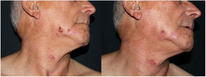 Placas eritemato-costrosas submandibulares, antes y después del tratamiento.