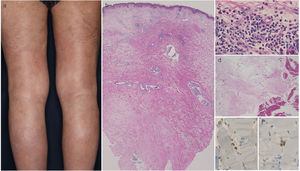 (a) Induración leñosa bilateral en extremidades inferiores. (b) Características histológicas de esclerosis dérmica difusa, tejidos conjuntivos septales fibrosos engrosados con infiltrado de células mononucleares al tejido subcutáneo. (c) A mayor aumento se observa infiltrado perivascular que contiene varios eosinófilos en la dermis superior. (d) Pequeño número de infiltrados de células mononucleares en la fascia engrosada. Células T CD4- (e) y CD8- (f) positivas en los tejidos musculares. (Aumento, b: ×40, c: ×400, d: ×200, e: ×400, f: ×400).