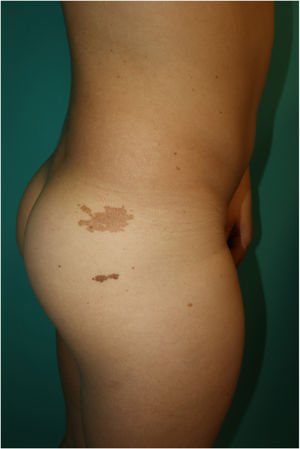 Brown macules with irregular borders on the buttock lateral side, and multiple lentigines on the trunk.