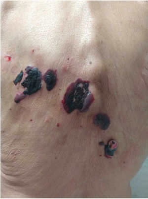 Atypical presentation. Large blisters located on the back, filled with hemorrhagic content revealing wider spread and a more severe condition (case #3).