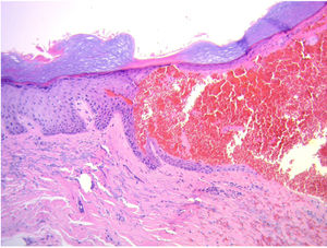 Histopathology (hematoxylin-eosin, 20x). Intraepidermal blister containing erythrocytes.