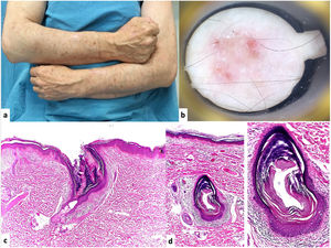 A. Clinical image of the dermatosis characterized by erythema and thin scale that coalesce in round-shaped plaques with discrete keratotic borders. B. Dermatoscopic image: presence of erythema and follicular distribution of scales without a defined dermatoscopic pattern. C. Hematoxylin and eosin (H&E) stain, ×10. Histopathology: the epidermis exhibits orthokeratotic hyperkeratosis and areas of moderate regular acanthosis. Within the dermal thickness, dilated follicular infundibula containing laminar keratin and columns of compact parakeratotic hyperkeratosis corresponding to cornoid lamellae can be seen, with such structures being connected to the follicular epithelium where there is an absence of the granular layer. D. Hematoxylin and eosin (H&E) stain, ×4 and ×40. In other areas of the section, cystic structures containing cornoid lamellae can also be seen, leading to a diagnosis of follicular porokeratosis.
