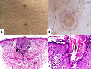 A. Clinical image showing papular lesions that coalesce to form brown-colored plaques. B. Dermatoscopic image of these millimetric lesions with a hyperkeratotic peripheral border and central scale, with the double-track sign, and a homogenous scar-like central region. C. Hematoxylin and eosin (H&E) stain, ×10. Histopathology: exhibits an epidermis with a cornified layer, basal layer hyperpigmentation, and a dilated follicular infundibulum in the central region of the section. In the superficial and middle dermis, moderately dense infiltrates are arranged in focal areas. D. Hematoxylin and eosin (H&E) stain, ×40. At higher magnification, areas without a granular layer and the presence of dyskeratotic cells can be seen, which means that this parakeratotic hyperkeratosis corresponds to the cornoid lamella.