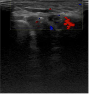 Ultrasound image. Small thickenings of subcutaneous cellular tissue, partially defined, without deep involvement. No pathological vascular structures or well-demarcated vascular enhancement foci.
