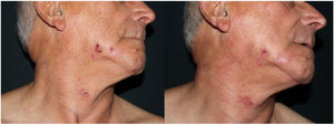 Erythematous-crusty submandibular plaques before and after therapy.