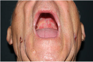 Ulcers on the palate.