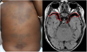 A) Presence of aberrant Mongolian spots on the trunk and at the root of the limbs. B) Bilateral arachnoid cysts.