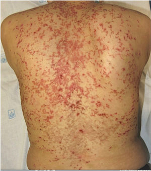Prurigo pigmentosa, keto rash. Multiple coalescing erythematous papules of reticular appearance located on the back. Hyperpigmented reticular plaques can be seen on the lower back region. The patient suffered from an eating disorder and was undergoing treatment for depression. Complete resolution of pruritus and erythematous plaques was seen after a 1-month course of doxycycline 100mg/day.