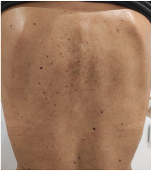 Prurigo pigmentosa, keto rash. Highly pruritic erythematous plaques on the dorsal back region. Note the subtle reticulated post-inflammatory hyperpigmentation on the central dorsal back region. The patient had been following a strict ketogenic diet for 4 months, resulting in significant weight loss. The clinical condition completely resolved after a 1-month course of doxycycline 100mg/day, along with diet discontinuation.