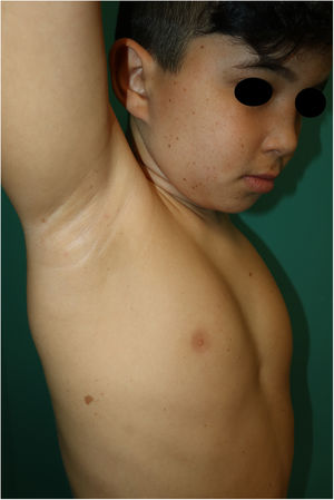 Múltiples lentigos en la región facial y mácula hiperpigmentada en cara lateral del tronco.