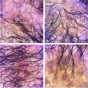 Tricoscopic findings. (a) Perifollicular scaling, erythema, dystrophic hairs, milky red areas, and shiny white structures. (b) Perifollicular scaling, erythema, incontinentia pigmenti signs, pili torti, dystrophic hairs, and fibrotic areas. (c) Perifollicular scaling, intense erythema, and incontinentia pigmenti signs. (d) Cicatricial alopecia with incontinentia pigmenti signs, dystrophic hairs, and empty follicles.