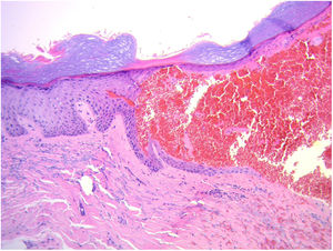 Histopatología (hematoxilina-eosina, 20x). Ampolla intraepidérmica de contenido eritrocitario.