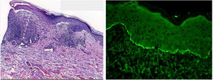 Vesiculación subepidérmica con infiltrado predominantemente mononuclear, fibrosis y depósitos lineales en lámina basal de inmunoglobulina G, C3 y fibrinógeno. A) 10x hematoxilina-eosina. B) Inmunofluorescencia directa 20x.