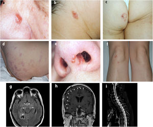 Imágenes clínicas de algunas lesiones cutáneas en pacientes con NS e imágenes de lesiones de NS obtenidas mediante resonancia nuclear magnética. a) Placa infiltrada en la nariz. b) Placa infiltrada en la cara lateral del cuello. c) Placa anular en el glúteo. d) Placas eritemato-violáceas en los glúteos. e) Lesiones de lupus pernio en la ventana nasal. f) Sarcoidosis papulosa de las rodillas. g) Resonancia nuclear magnética: secuencia FLAIR transversal que objetiva áreas de hiperintensidad mesencefálicas bilaterales y en hipotálamos. h) Resonancia nuclear magnética: secuencia T1 con gadolinio que muestra captación meníngea difusa. i) Resonancia nuclear magnética: secuencia STIR de médula con hiperintensidad del cordón medular compatible con mielitis transversa longitudinalmente extensa. FLAIR: fluid attenuated inversion recovery; NS: neurosarcoidosis; STIR: short-tau inversion-recovery.