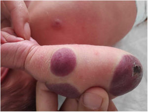 Ulceración central de la anomalía situada sobre el codo.