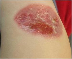 Involución espontánea de la lesión situada sobre cara externa de antebrazo.