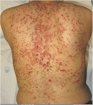 Prurigo pigmentosa, keto rash. Múltiples pápulas eritematosas coalescentes de aspecto retiforme en la espalda. Se observa en la zona lumbar la presencia de placas hiperpigmentadas de conformación retiforme. La paciente presentaba un desorden alimenticio y estaba en tratamiento por depresión. Se observó una resolución completa del prurito y de las placas eritematosas tras el tratamiento con doxiciclina 100mg/día por un mes.