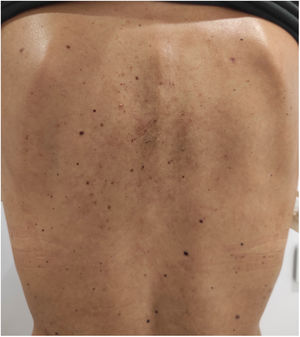 Prurigo pigmentosa, keto rash. Placas eritematosas muy pruriginosas en la espalda dorsal. Nótese la sutil hiperpigmentación postinflamatoria reticulada en la zona dorsal central. La paciente seguía una dieta cetogénica estricta desde hacía 4 meses, con una significativa reducción de peso. El cuadro clínico remitió completamente tras la administración de doxiciclina 100mg/día por un mes, junto con el cese de la dieta.