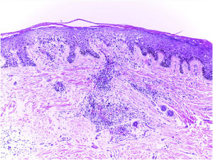 Hallazgos anatomopatológicos: trastornos de maduración epidérmica con hiperqueratosis, degeneración vacuolar de la capa basal y espongiosis focal; infiltrado dérmico linfohistocítico perivascular y perianexal, con reducción de unidades foliculares, fibrosis intersticial y extravasación de eritrocitos en la dermis (hematoxilina–eosina, ×100).