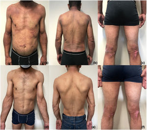 Paciente con dermatitis atópica al inicio (a–c), y transcurridos 6 meses del tratamiento con dupilumab (d–f).