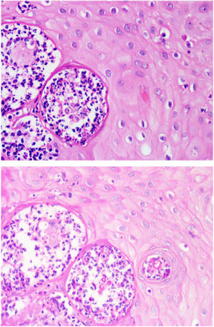 Above, 40x, hematoxylin and eosin, below, 40x, PAS).
