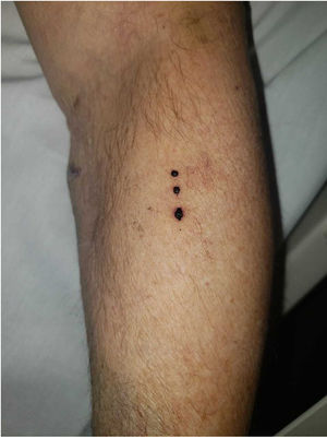 Typical presentation. Tense hemorrhagic blisters with a linear distribution of left forearm location (case #1).