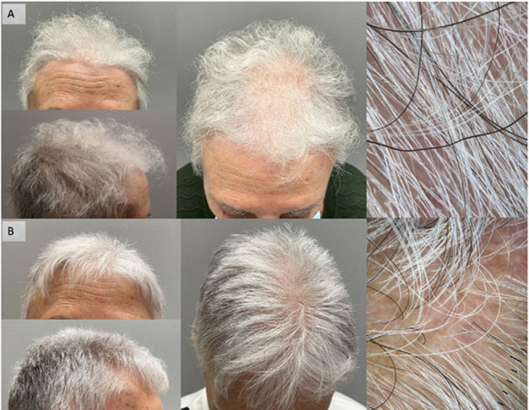 Translated Article Progressive Kinking Of The Hair And Pili Torti translated-article-progressive-kinking-of-the-hair-and-pili-torti