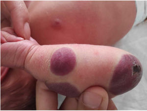 Central ulceration of the anomaly located on the elbow.