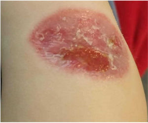 Spontaneous regression of the lesion located on the forearm outer region.