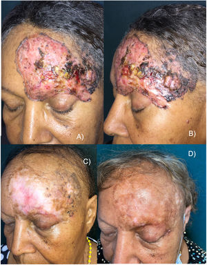 A y B) Aspecto del tumor antes de comenzar el tratamiento. Placa eritematosa, con áreas erosionadas, ulceradas, costrosas y con abundante pigmento. C) Tras 18 meses con vismodegib. Respuesta parcial del tumor. Observamos alopecia como toxicidad característica de este fármaco. D) A los 30 meses de seguimiento (12 meses tras la suspensión de vismodegib). Remisión clínica completa, repigmentación significativa y alopecia en repoblación.