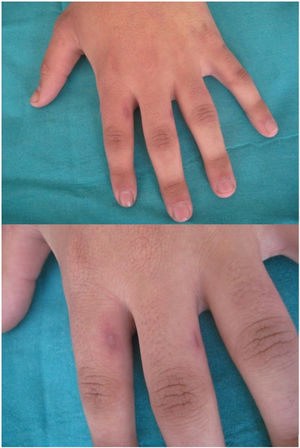 Results after treatment with CO2 laser vaporization.