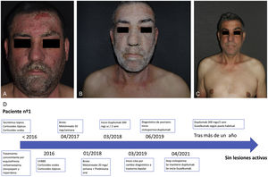 a) Lesiones eccematosas con gran afectación de la cara. b) Lesiones de psoriasis extensas que afectaban fundamentalmente a cara, cuello y miembros superiores tras inicio de litio. c) Sin lesiones activas tras más de un año de guselkumab y dupilumab. d) Línea temporal de tratamientos.