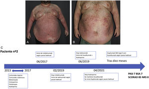 a) Lesiones eccematosas y psoriasiformes con afectación generalizada. b) Buen control de la psoriasis y mal control de la dermatitis atópica tras 10 meses de guselkumab y dupilumab. c) Línea temporal de tratamientos.