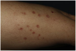 Imagen clínica. Múltiples pápulas poligonales eritemato-violáceas y brillantes de hasta 1cm en antebrazos.
