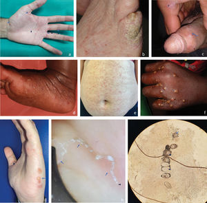 Imágenes clínicas y microscópicas de escabiosis; a) forma clásica en adulto joven con fototipo 3, con surcos acarinos (flechas) y pápulas (puntas de flecha) evidentes en localizaciones típicas de la mano; b) forma costrosa o noruega (hiperinfestación) en anciana encamada con fototipo 2, con alteración ungueal y lesiones costrosas discretas en meñique, que hacen difícil el diagnóstico de sospecha; c) nódulos y erosiones genitales (flecha) y surco acarino (punta de flecha) en adulto joven con fototipo 5; d) acropustulosis escabiótica, pústulas en planta de pie en bebé de 3 meses de fototipo 6; e) forma atípica con lesiones eccematosas diseminadas (se muestra abdomen) en mujer de edad media y fototipo 3; f) forma clásica impetiginizada, pústulas en localización típica de escabiosis en mano de niña de 8 años y fototipo 6; g) forma atípica ampollosa, con ampollas en lateral de mano (flecha) y un surco acarino en pulgar (punta de flecha) en mujer joven con fototipo 3; h) imagen de surco acarino obtenida mediante dermatoscopio manual. En un extremo se visualiza el triangulo oscuro que corresponde a la sección anterior del ácaro (punta de flecha). De él parte el trayecto lineal sinuoso que termina en una imagen triangular (flechas). Estas estructuras constituyen el «signo de ala delta; i) imagen del ácaro (flecha) y sus huevos (puntas de flecha) obtenida mediante microscopía óptica del raspado de un surco acarino.