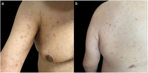 PLC inducida por la vacuna antigripal. Lesiones eritematoso-descamativas localizadas en el tórax y el brazo derecho (a) y la región dorsal (b). PLC: pitiriasis liquenoide crónica.