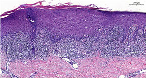 Anatomopathological image. Hematoxylin-eosin staining, 9.6 ×. Presence of focal parakeratosis, lichenoid dermatitis with a predominance of lymphocytes, apoptotic keratinocytes (Civatte bodies), and images of pigmentary incontinence. Mild vacuolar degeneration of the interface.