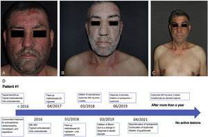 a) Eczematous lesions with significant face involvement. b) Extensive psoriatic lesions mainly affecting the face, neck, and upper limbs after starting lithium therapy. c) No active lesions were reported after more than a 1 year on guselkumab+dupilumab. d) Treatment timeline.