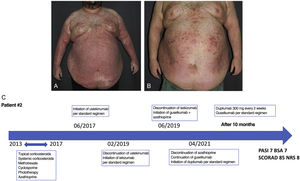 a) Eczematous and psoriasiform lesions with widespread involvement. b) Good psoriasis control, and poor atopic dermatitis control after a 10-month course on guselkumab+dupilumab. c) Treatment timeline.