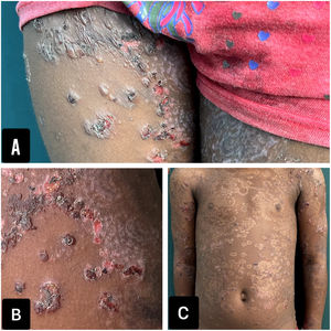 Fotografías clínicas. A y B) Muslos con ampollas tensas y costras hemorrágicas distribuidas en rosetas. C) Máculas hipopigmentadas residuales, con un patrón en rosetas.