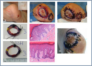 A) Recidiva de melanoma acral en el talón del pie izquierdo confirmada con biopsia parcial de MLA in situ (flecha roja). Véase dermatoscopia con patrón paralelo de la cresta. En la imagen se aprecia una cicatriz de exéresis de melanoma in situ adyacente (asterisco). B) Tratamiento mediante técnica del espagueti, utilizando como control negativo la ampliación del otro melanoma in situ completamente extirpado adyacente. Exéresis a 45° de ambos espagueti y referencia en dos puntos con seda. C) Los defectos se suturan directamente. D y E) Marcaje de las piezas por el patólogo en cuatro puntos 12, 3, 9 y 6h e inclusión en macrobloques. F) Imagen histológica (hematoxilina eosina 10x) de la primera etapa positiva con hiperplasia melanocítica atípica. G) Imagen histológica (hematoxilina eosina 10x) del control negativo. H) Realización de la segunda etapa en zonas positivas de 12-1h y 6-9h que resultó negativa. MLA: melanoma lentiginoso acral.