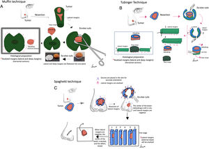 Paraffin-embedded margin-controlled Mosh micrographic surgery. (A) Muffin technique. After resection, deep incisions are performed at 6 and 12 o’clock, and the lateral margins are then folded laterally to a horizontal plane (same plane of the base), which is then cut after being formaldehyde-fixed and paraffin-embedded in a horizontal plane starting from the bottom of the specimen. A representative cross-section through the central part of the tumor (debulking) can aid in diagnostic classification. (B) Tübingen technique. After resection, a narrow (1–3mm) lateral marginal strip is cut around the entire perimeter of the tumor edge. The strip is then laid flat on the peripheral side and then cut into pieces that are placed in routine cassettes for histopathological examination. Subsequently, a horizontal section is cut from the bottom of the excised sample and also positioned flat on a histology cassette. (C) Spaghetti technique. A narrow band of skin, ‘the spaghetti’, is resected 3–5mm beyond the clinically/dermoscopically apparent perimeter of the tumor and sent for histopathological examination without tumor removal. The same procedure is repeated beyond the segments which are shown to be “tumor positive” and then until all lateral margins are tumor-free.