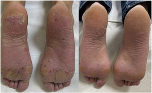 Hyperkeratotic eczema on the soles of the feet with improvement after 6 months on dupilumab.