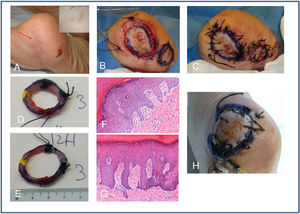 A) Recurrence of acral melanoma on the left heel confirmed by partial biopsy of in situ ALM (red arrow). Note dermoscopy with parallel ridge pattern. The image shows the scar of an adjacent excision of in situ melanoma (asterisk). B) Treatment with the spaghetti technique using the enlargement of the other completely excised adjacent in situ melanoma as negative control. Excision at 45 degrees of both spaghetti and reference at 2 points with silk. C) The defects are sutured directly. D and E) Pathologist